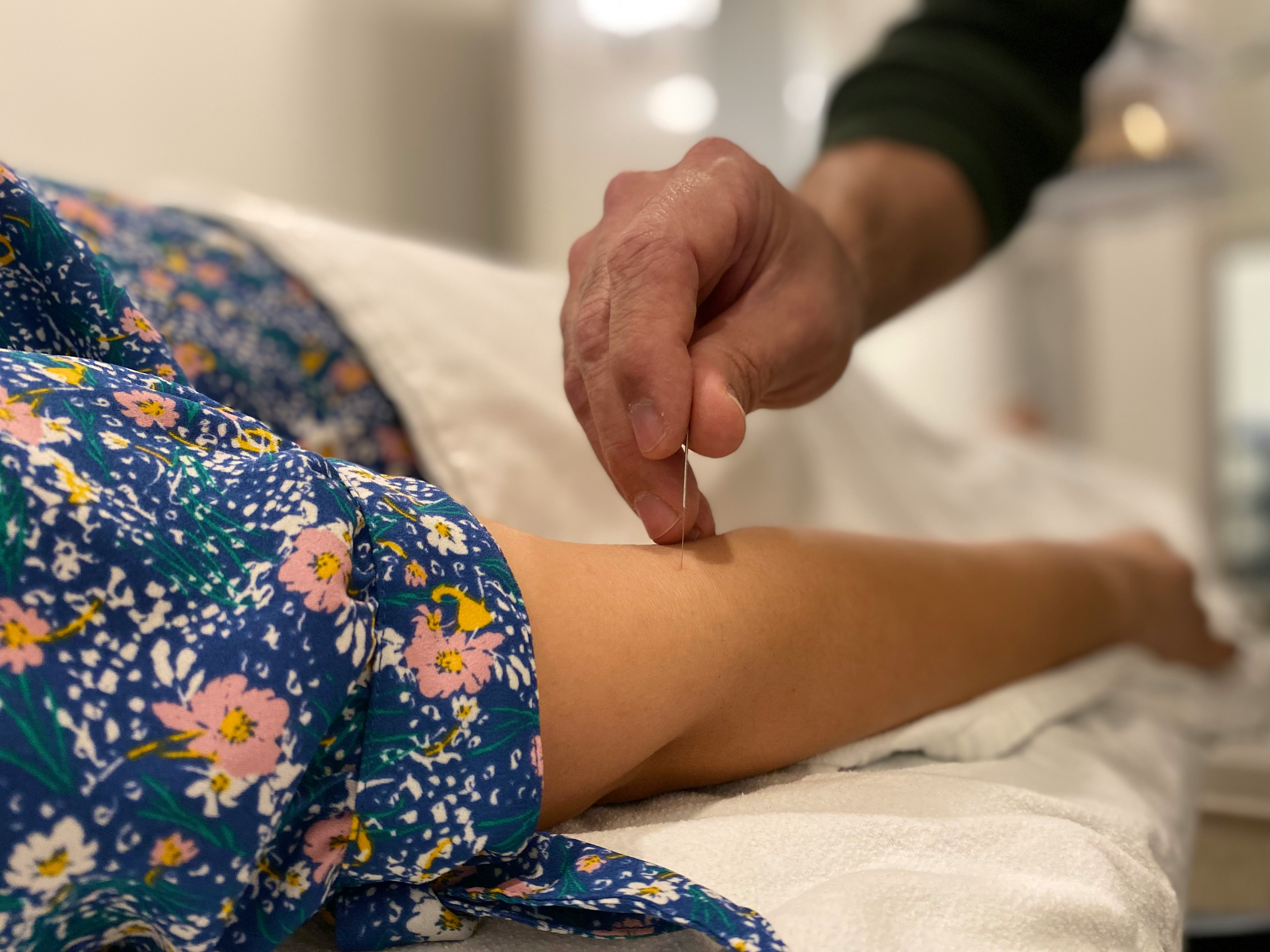 acupuncture needles being applied