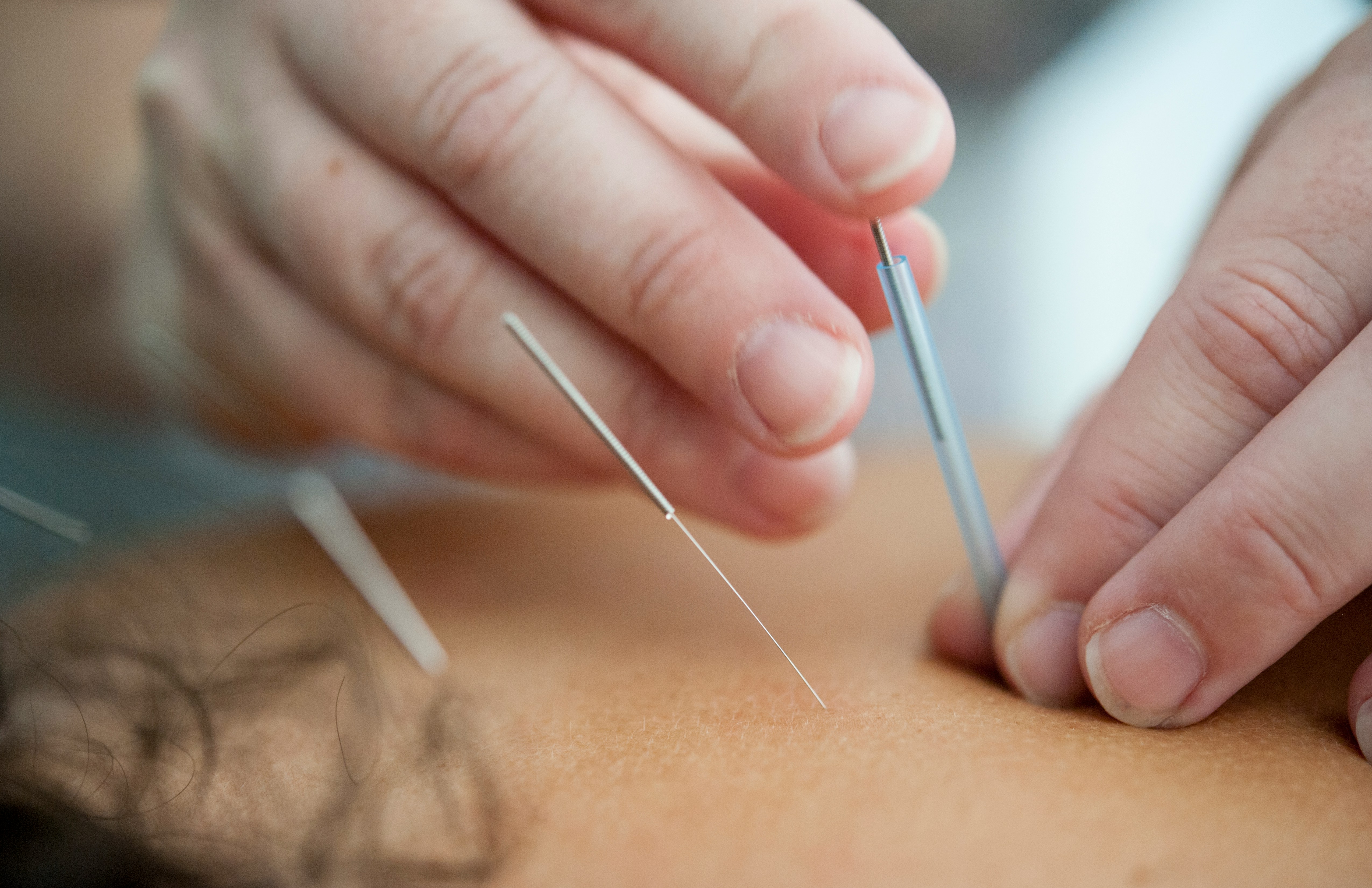 image of acupuncture needles