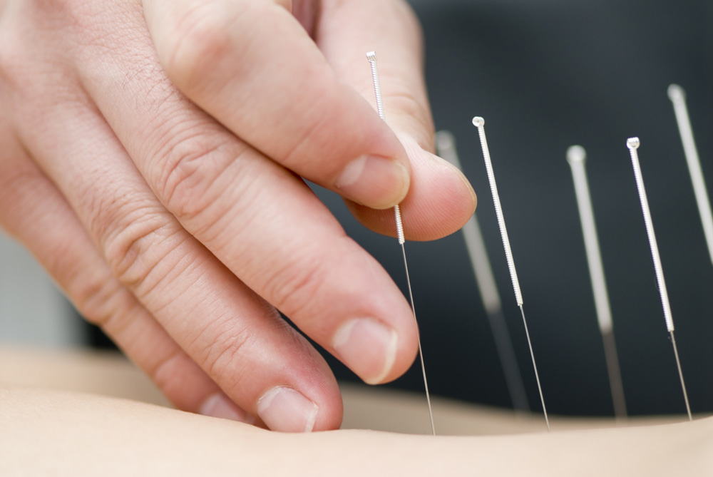 image of acupuncture needles